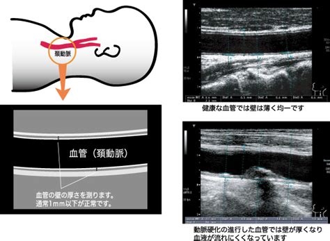 首 脈|頸動脈エコーでわかることは？｜動脈硬化を調べる超音波検査に 